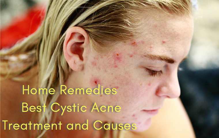 Cystic Acne Cure and Causes